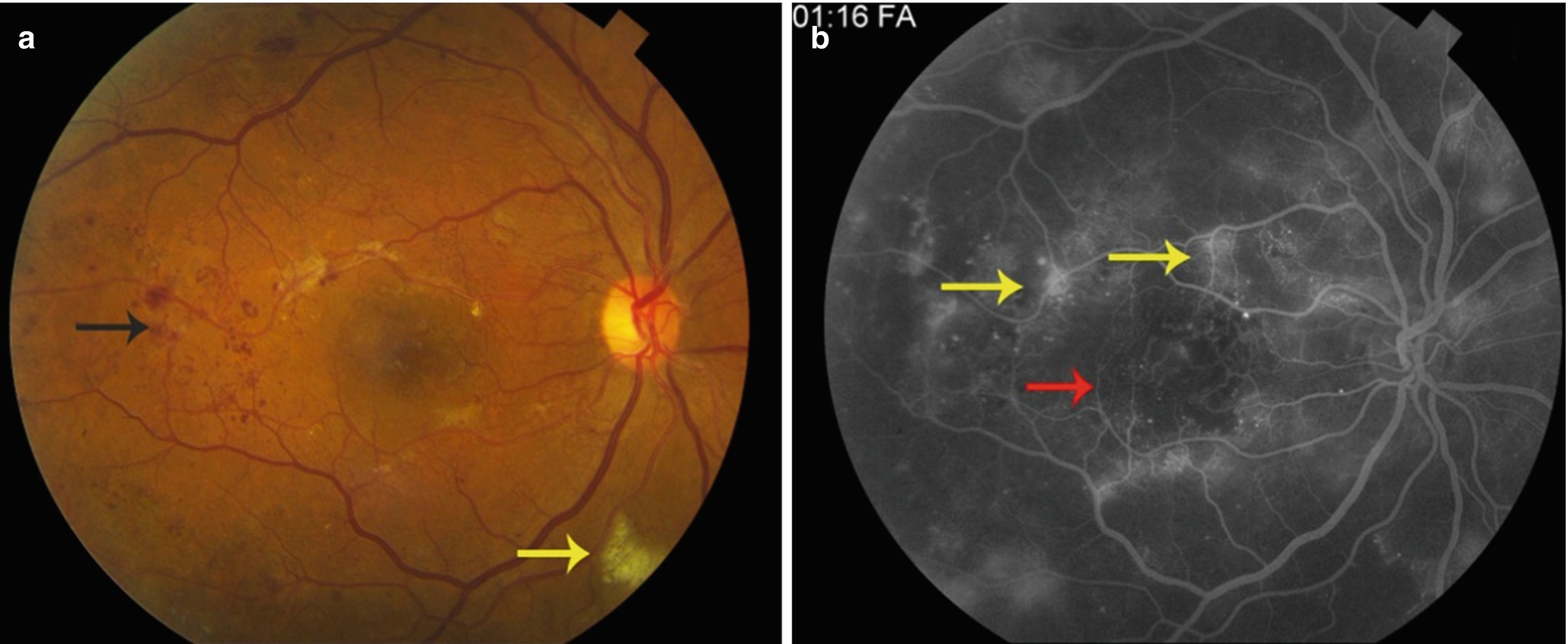 Imaging Of Retinal Vascular Disease Springerlink Imaging Of Retinal Vascular Disease Springerlink
