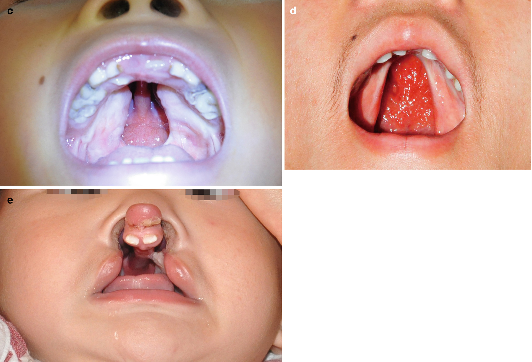 National Cleft Craniofacial Awareness Prevention Month Transforming Faces
