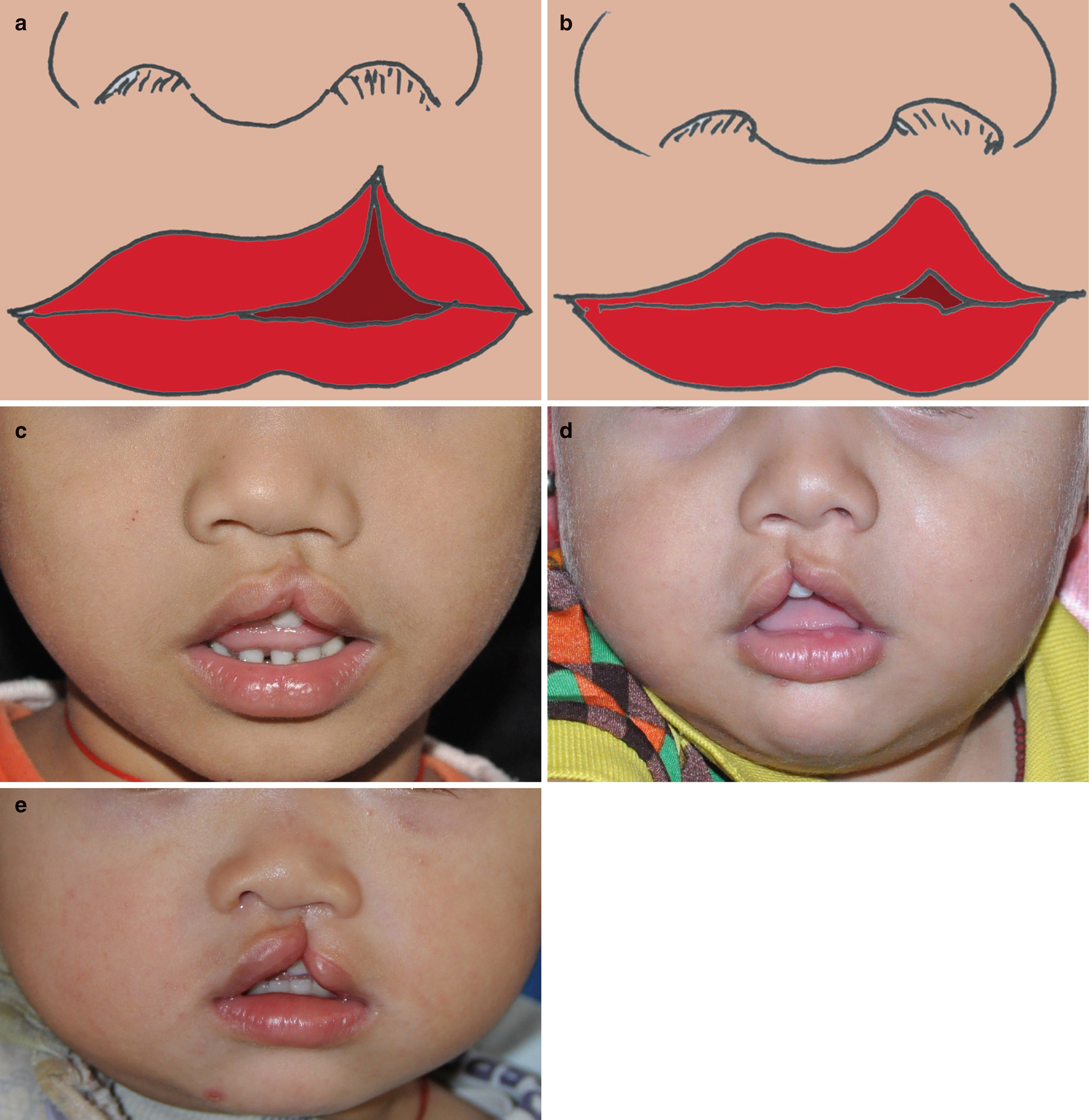 Classification Of Cleft Lip And Palate Springerlink