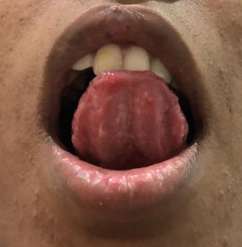My bubble tongue under Ranula