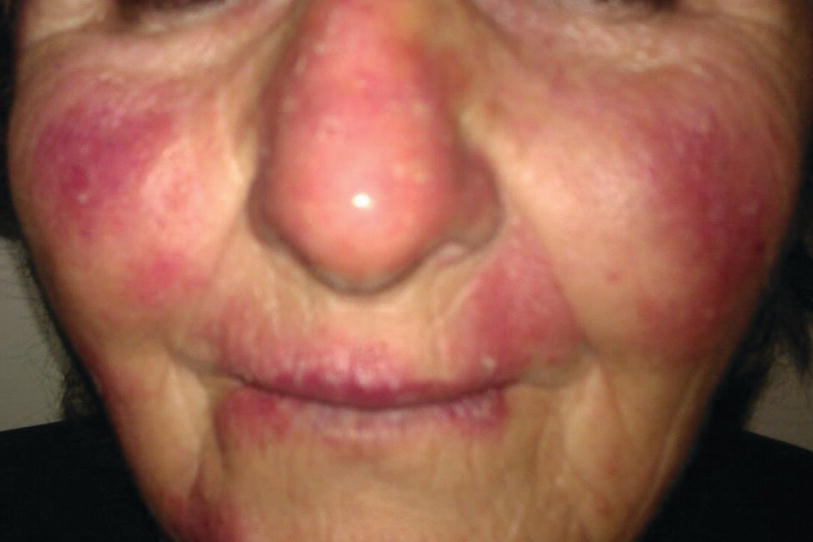 Sarcoidosis Springerlink
