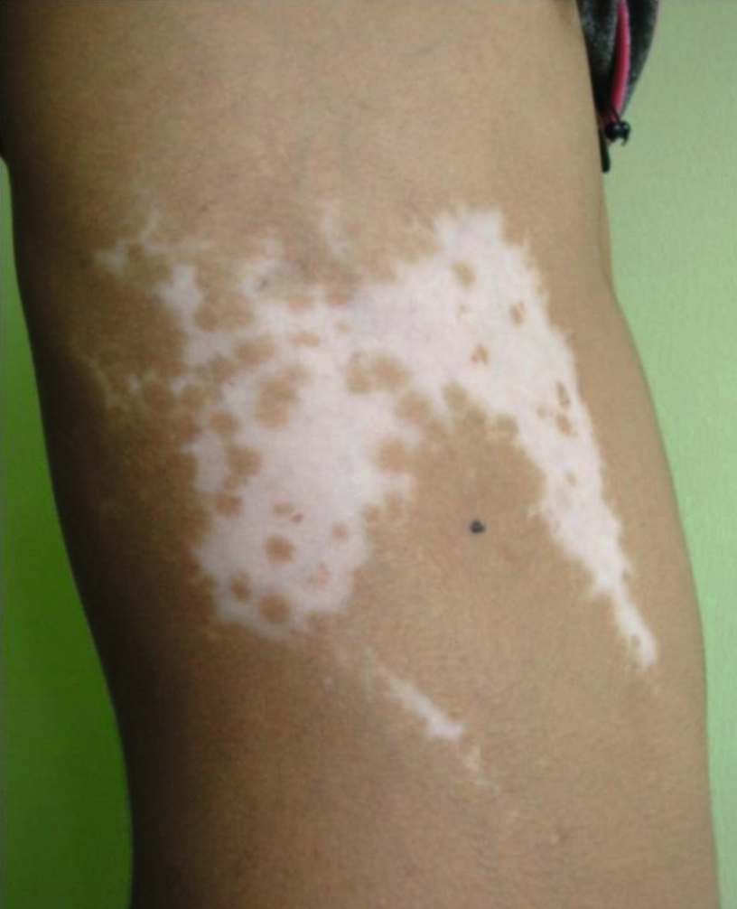 Penis vitiligo Gallery: Vitiligo