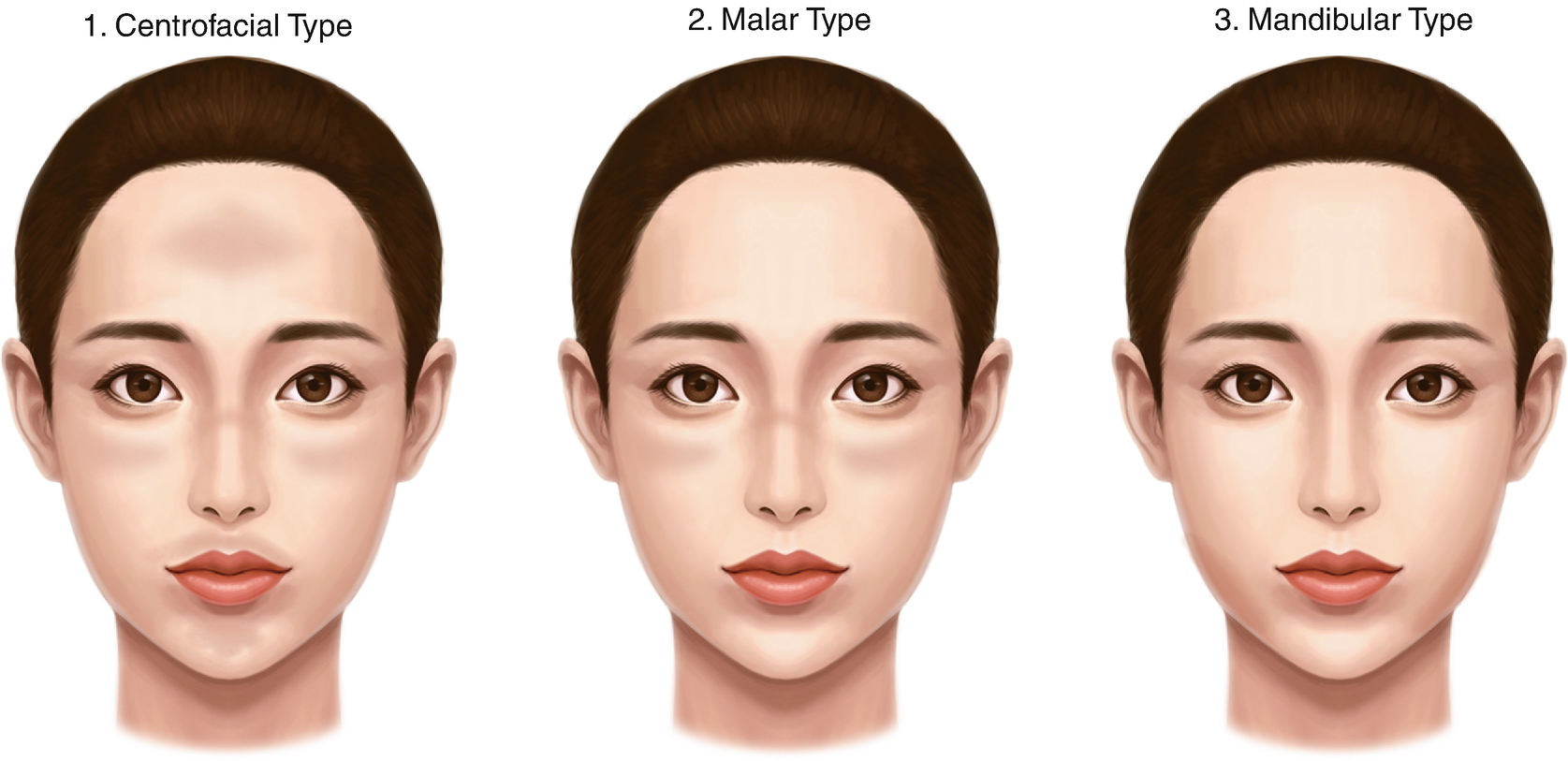 melasma cure