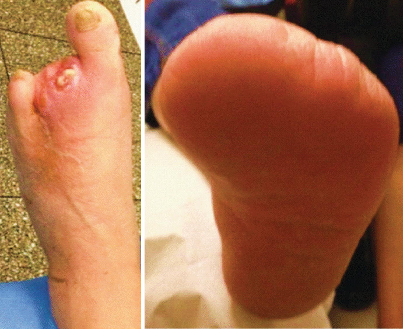 bmj best practice diabetic foot méry vércukormérő árgép