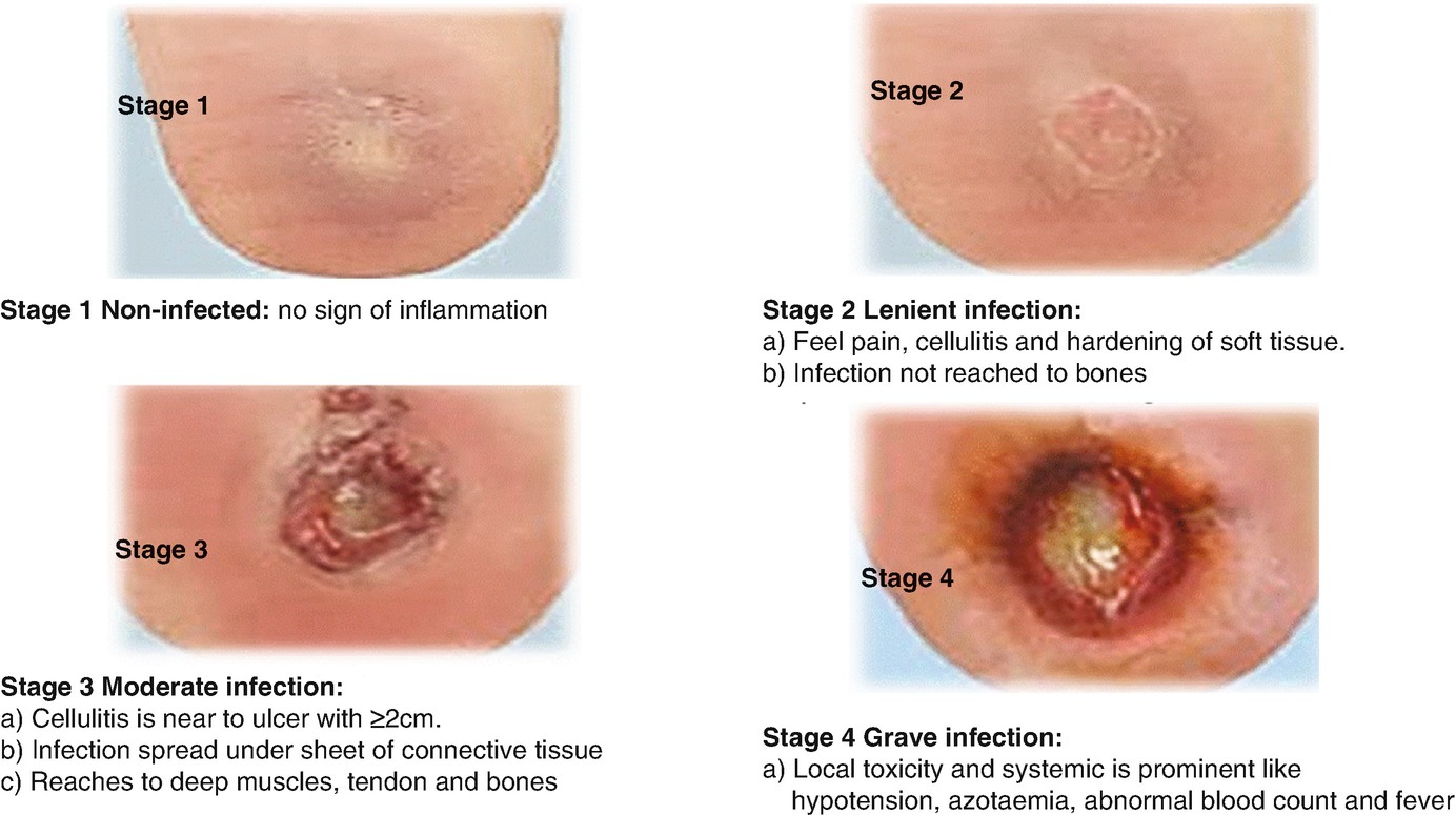 diabetic foot stages