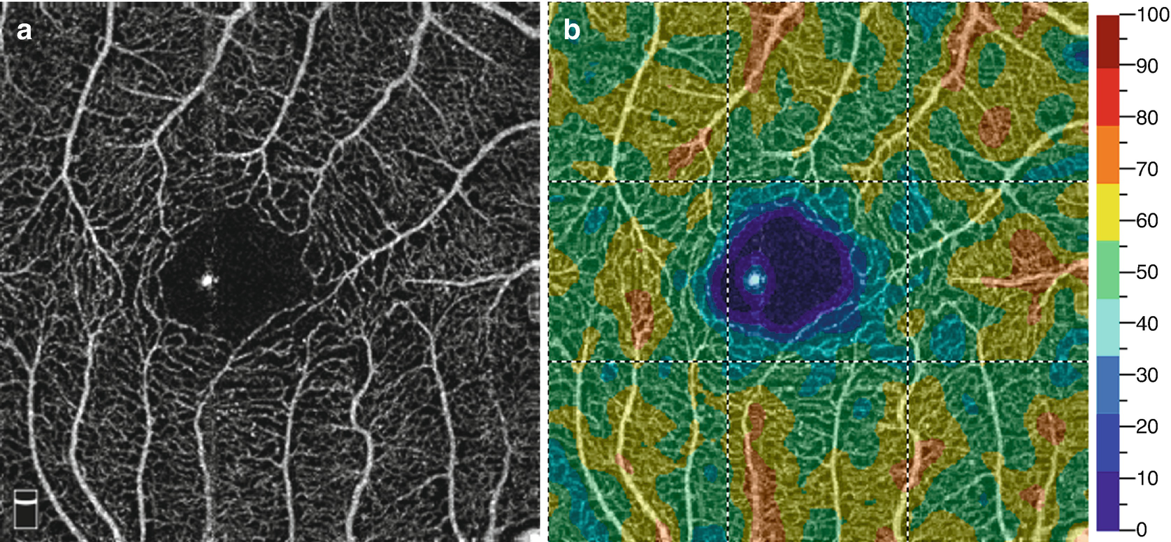 Optical Coherence Tomography Angiography In Macular Disorders Springerlink Optical Coherence Tomography Angiography In Macular Disorders Springerlink