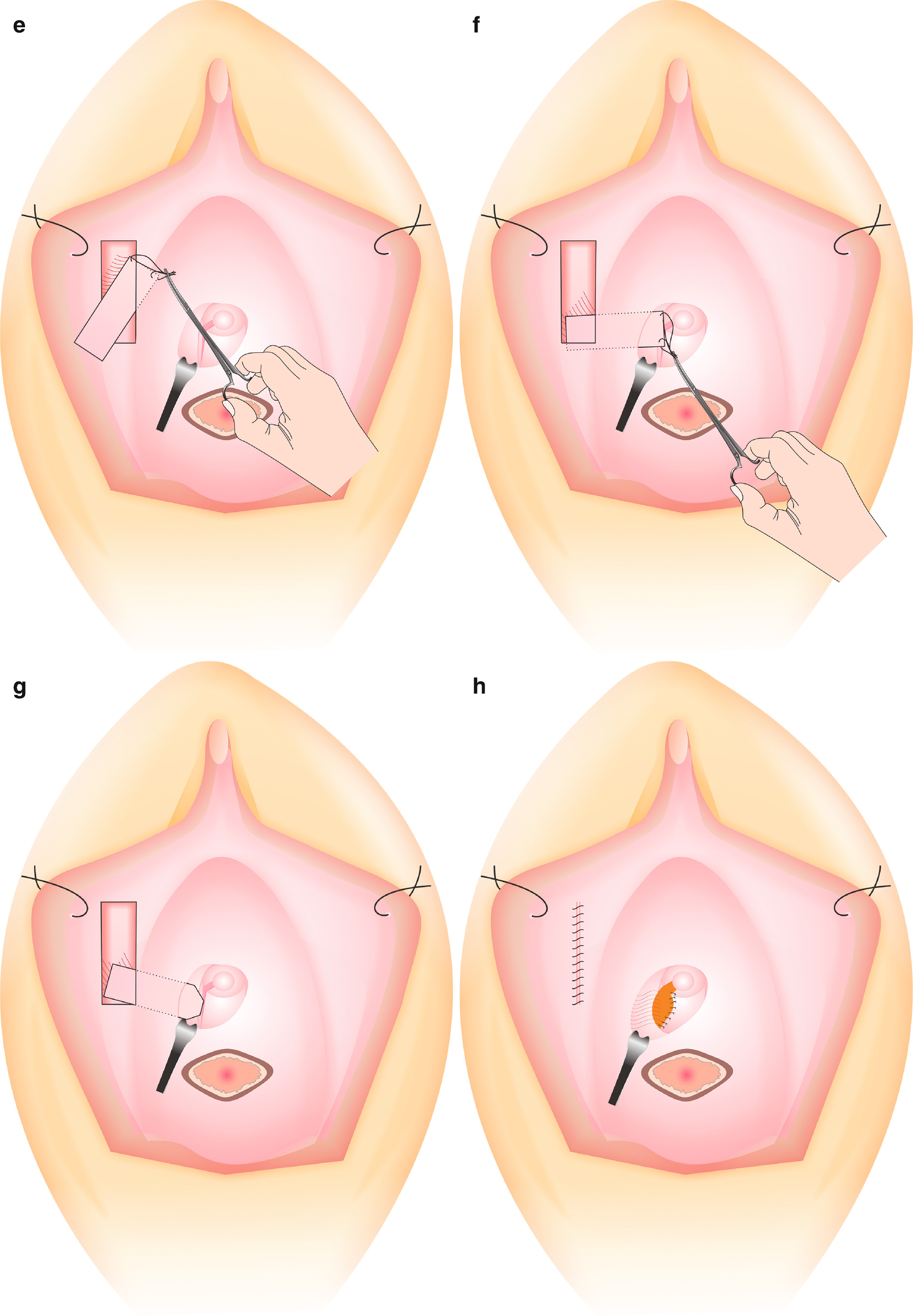 varcare recenzii pelvis mici