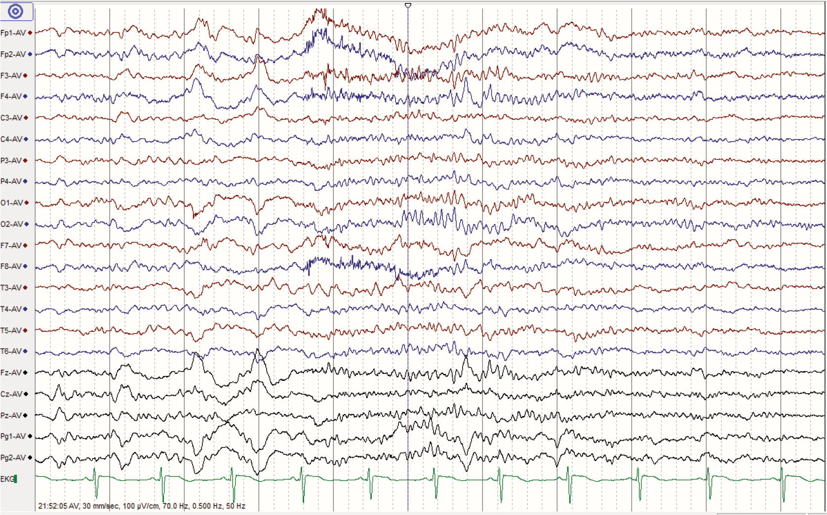abnormal eeg waves abnormal eeg waves