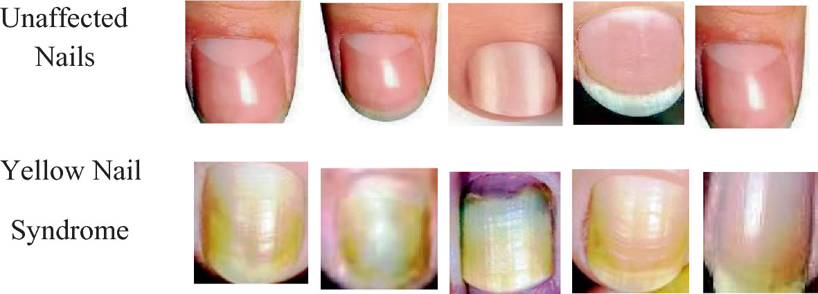 Vision Transformer Framework Approach for Yellow Nail Syndrome Disease  Identification | SpringerLink
