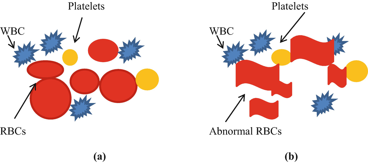 Beta Thalassemia Springerlink