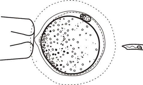 In Vitro Fertilization Springerlink - 