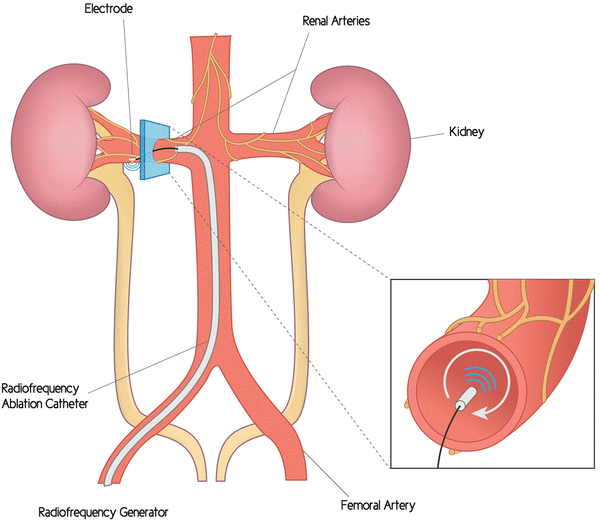 Renal Denervation SpringerLink
