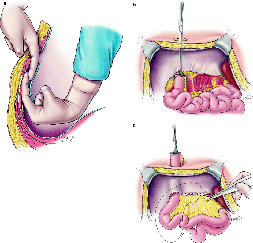 Stoma Prolapse SpringerLink