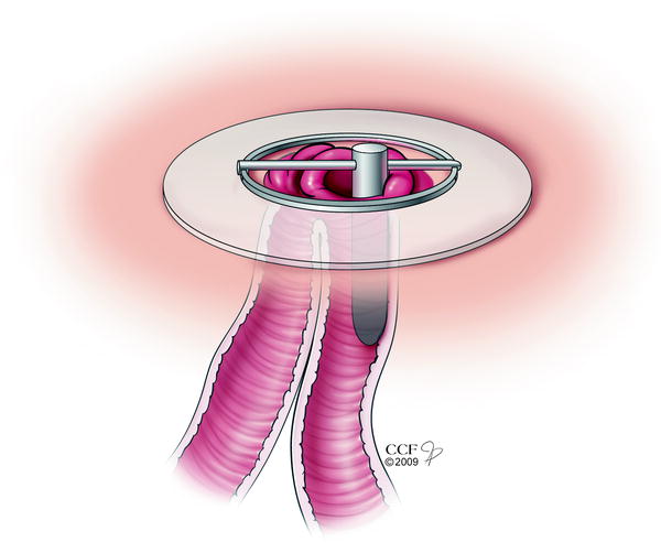 Stoma Prolapse SpringerLink