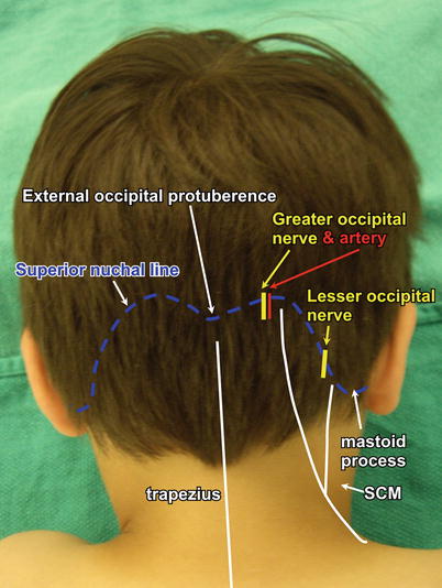 Occipital Nerve Blocks | SpringerLink