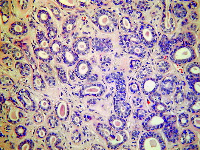 Cysts, Non neoplastic Glandular Lesions, and Glandular Neoplasms of the