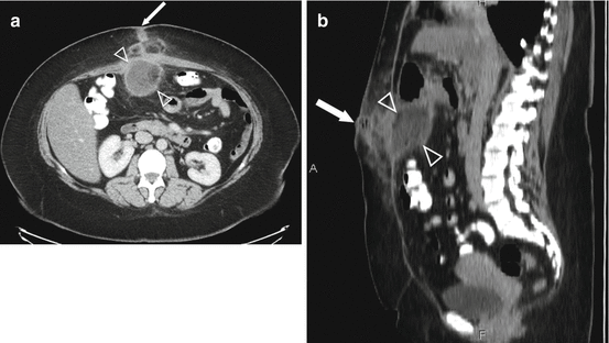 Post Operative Abdominal Wall Cellulitis Springerlink 6020