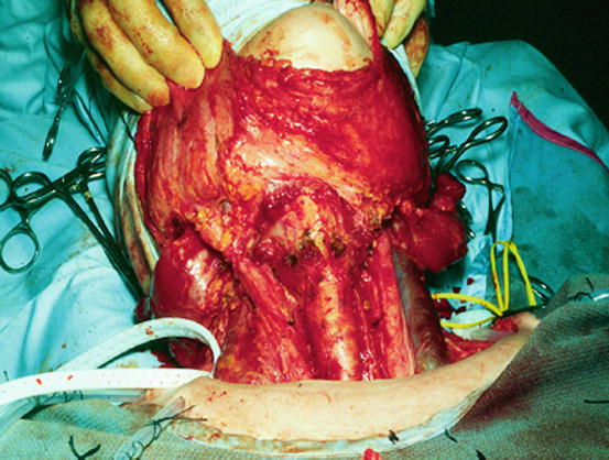 early stage cancer lymph nodes in neck early stage cancer lymph nodes in neck