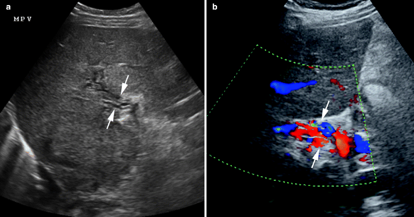 Ultrasound of the Hepatoportal Circulation | SpringerLink