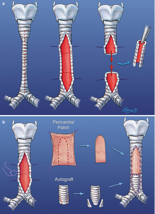 Vascular Rings, Tracheoplasty, and Pulmonary Artery Sling | SpringerLink