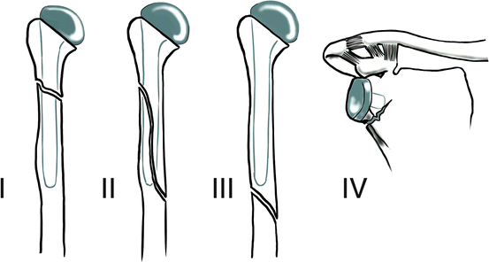 Periprosthetic Proximal Humeral Fractures | SpringerLink