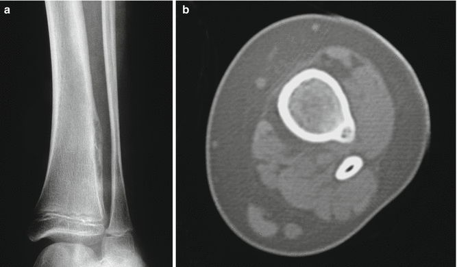 Osteoid Osteoma | SpringerLink