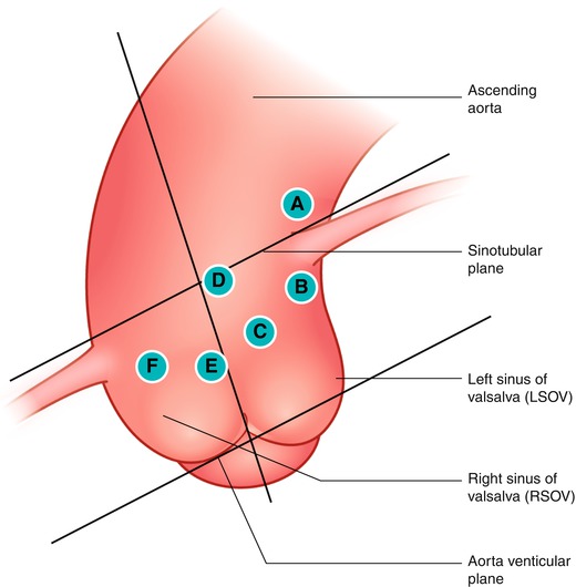 Guide Catheter Selection SpringerLink
