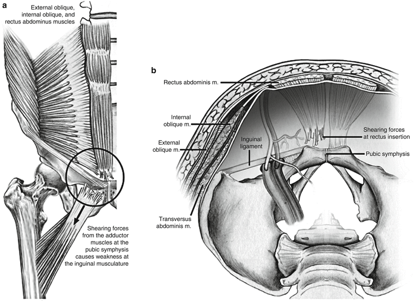 Special Patients and Conditions Sports Hernia SpringerLink
