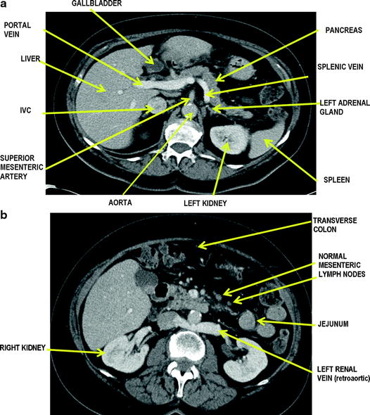 abdominal lymph nodes abdominal lymph nodes