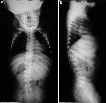 Hypochondroplasia | SpringerLink