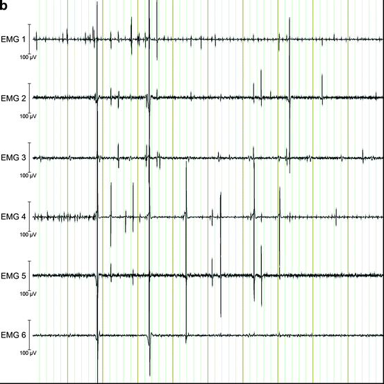 Cortical Myoclonus, EEG-EMG, Back-Averaging, and Coherence Analysis