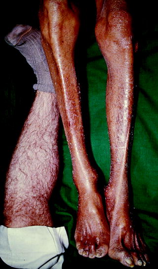 Bronze Diabetes - DiabetesWalls