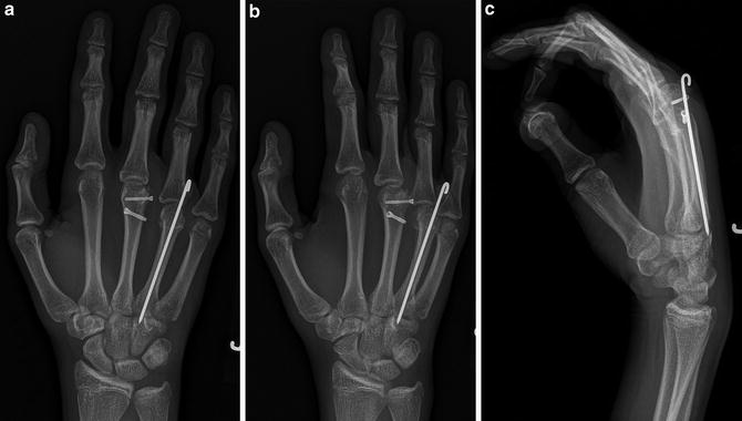 Metacarpal Fractures | SpringerLink