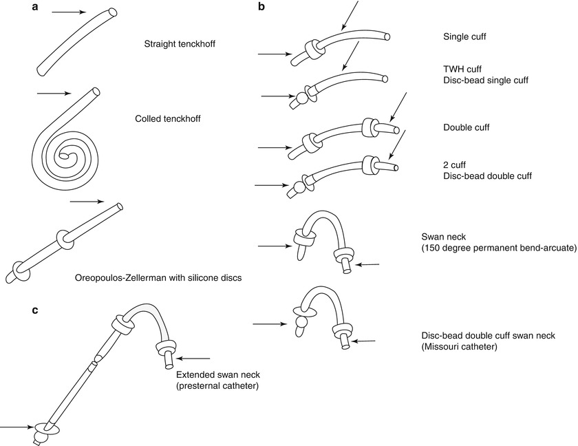 Operative Considerations for Peritoneal Dialysis Catheter | SpringerLink