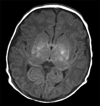 preterm ischemic encephalopathy hypoxic fig