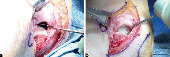 Tennis Elbow Complications of Surgical Treatment and