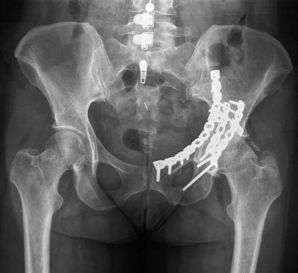 erinwheatleydesign Post Traumatic Arthritis Shoulder