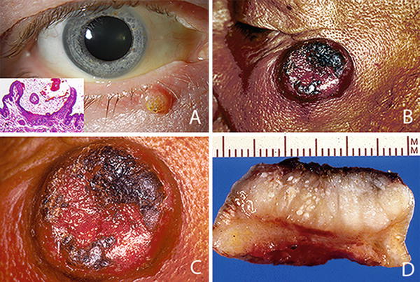 Eyelid and Periocular Skin Tumors  SpringerLink
