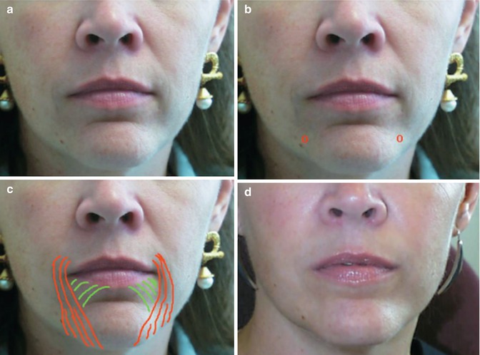 Perioral Botulinum Toxin Injections | SpringerLink Perioral Botulinum Toxin Injections | SpringerLink