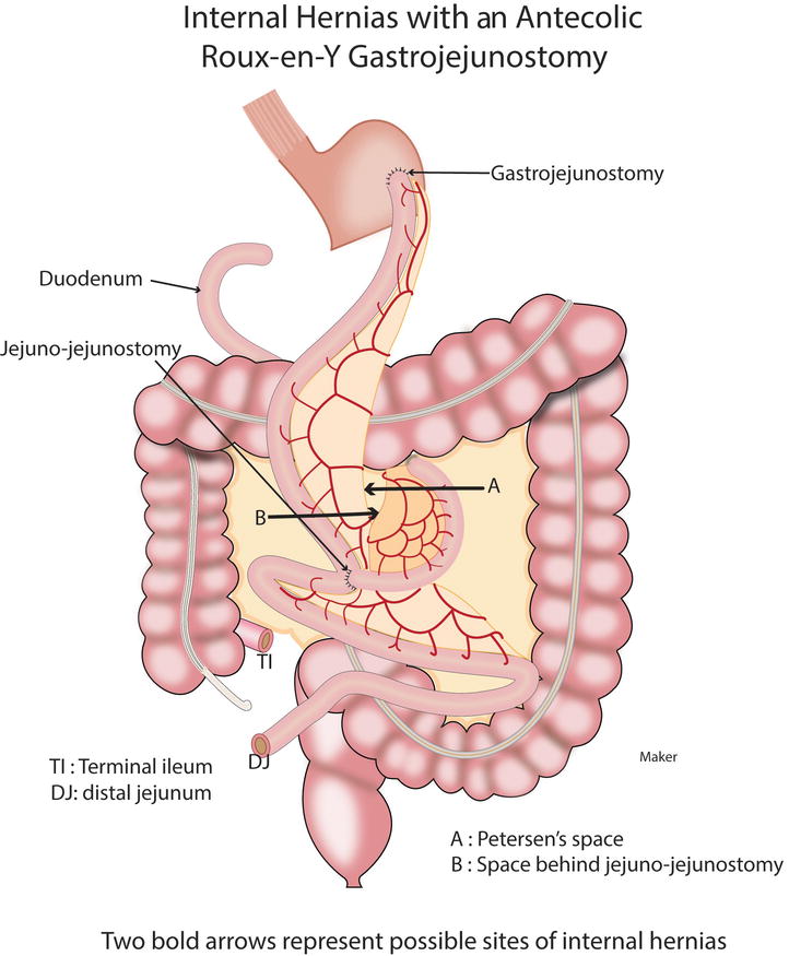 Peritoneum Omentum And Internal Hernias Springerlink