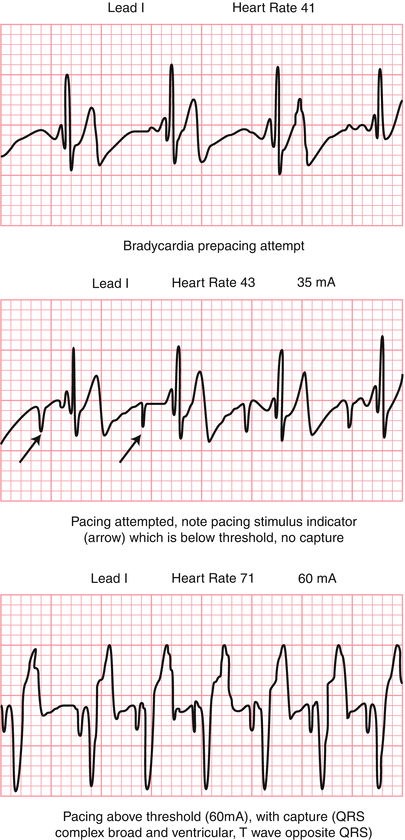 Transcutaneous Pacing | SpringerLink