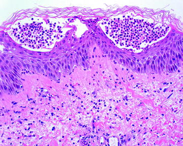 Psoriasiform Dermatitis | SpringerLink