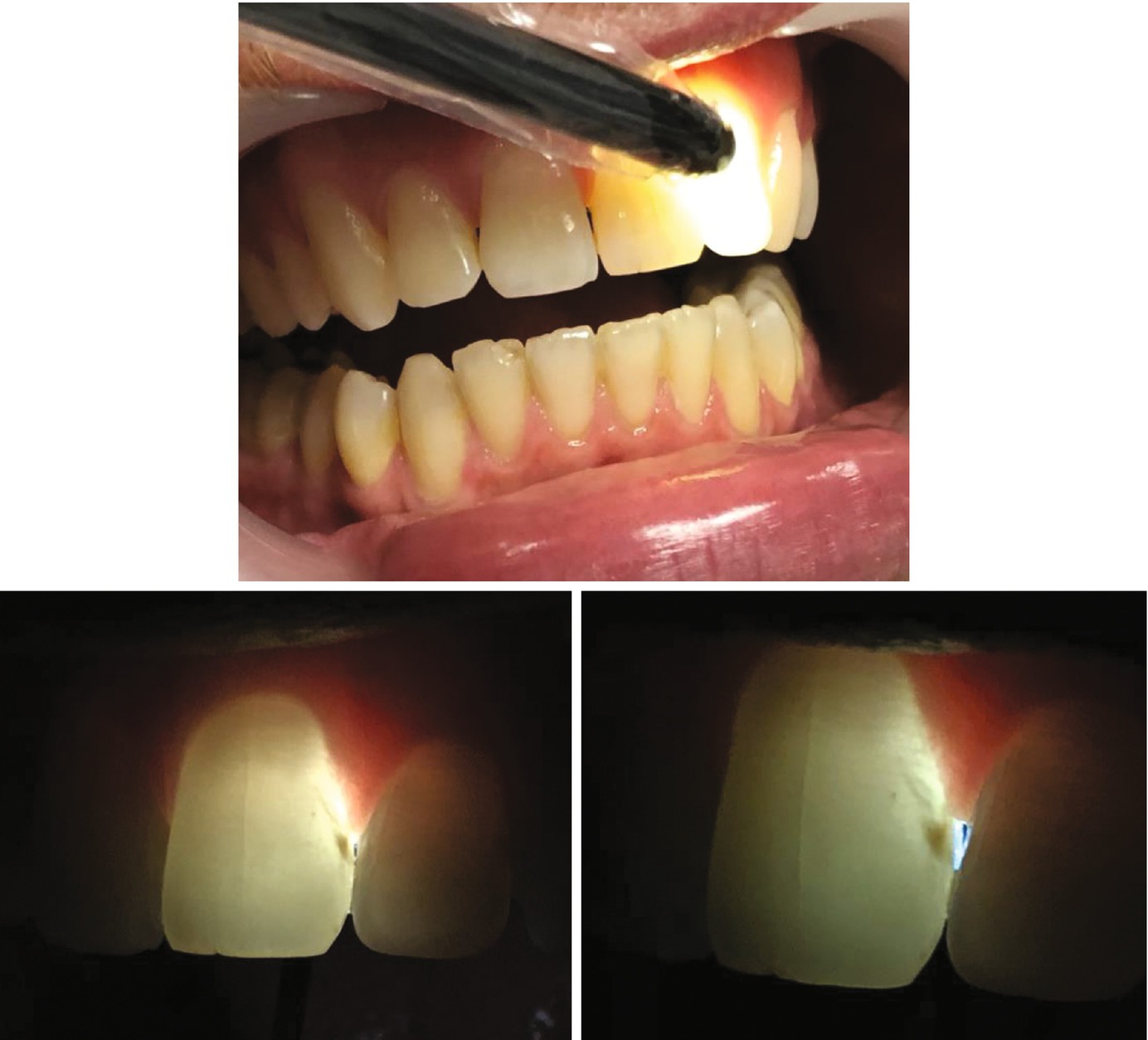 Transillumination Light Dental