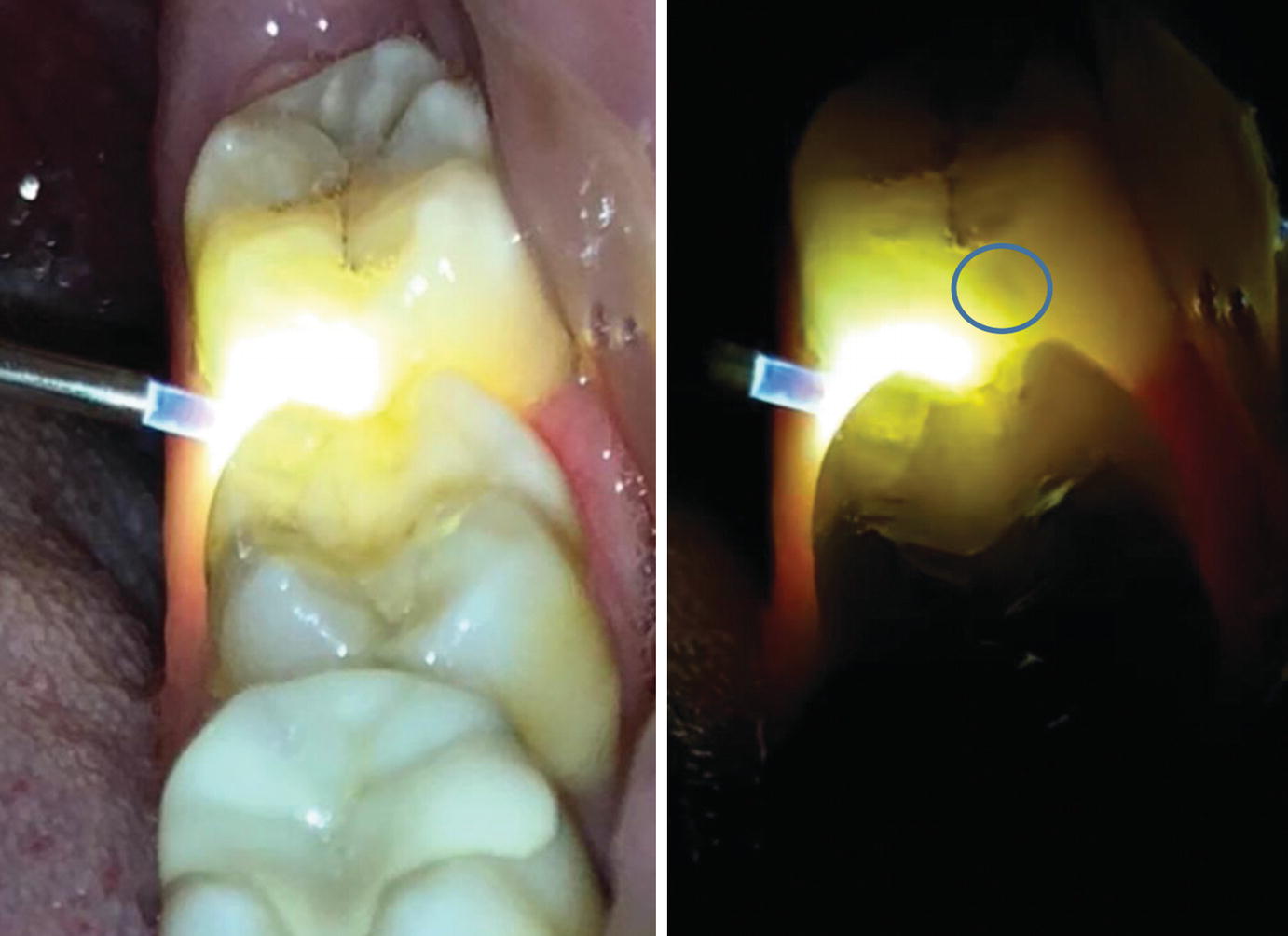 Transillumination Light Dental