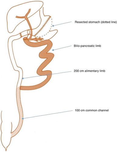 Laparoscopic Biliopancreatic Diversion with Duodenal Switch (BPD-DS ...