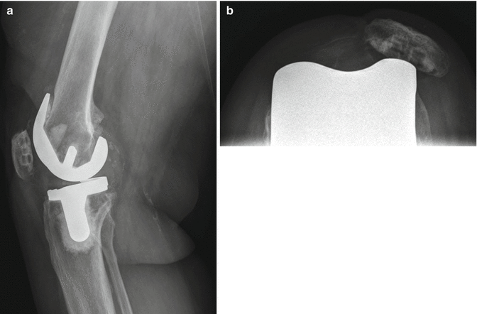 18 Causes and Diagnosis of Aseptic Loosening After Total Knee ...