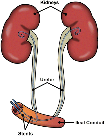 Ureteral Stents, Nephrostomy Tubes, and Urethral Dilators | SpringerLink