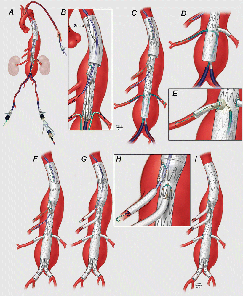 Techniques of Implantation of Fenestrated and Multibranched Stent ...