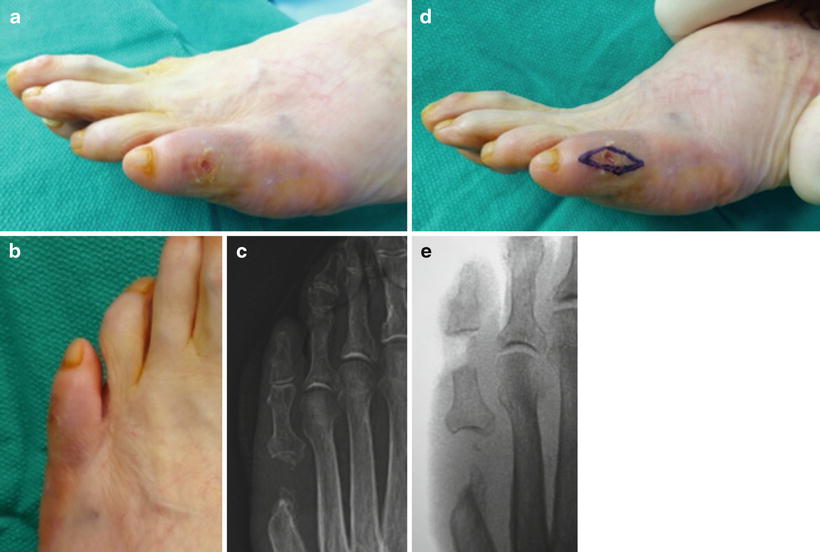 Fifth Ray Osteomyelitis SpringerLink