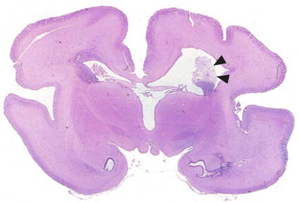 Macerated Stillbirth SpringerLink